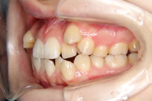 上の犬歯が側切歯と重なって八重歯になっています